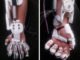 Dank einer neuartigen Exoskelett-Hand können Menschen, die eine gelähmte Hand haben, wieder ihre Hand bewegen. mz im Interview.